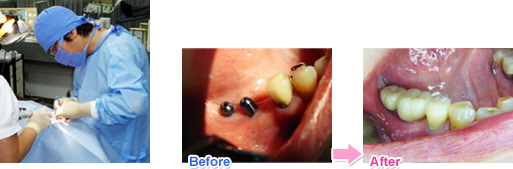 �C���v�����g����