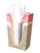 �C���v�����g����